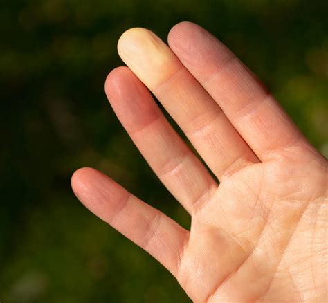 largest  genetic study  raynauds phenomenon  lead