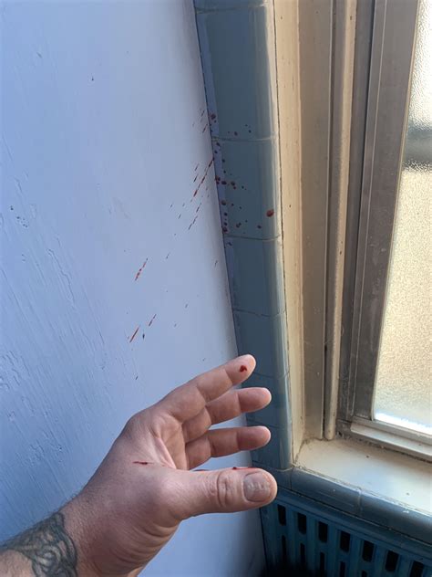 I found a large lump on my thigh when I was on the toilet. So