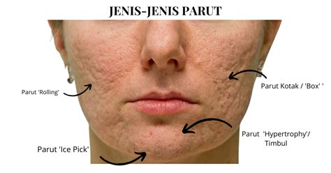 parut jerawat dr diana clinic