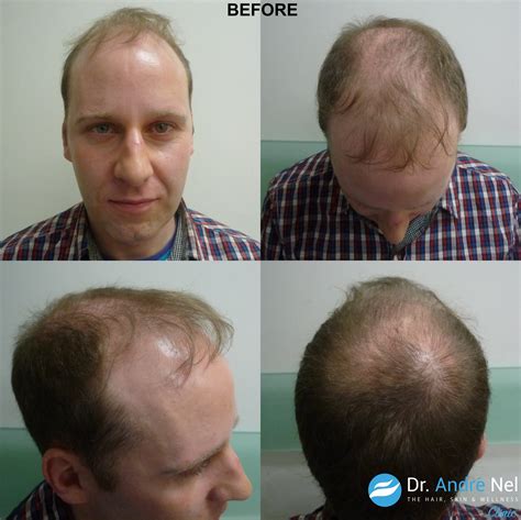 norwood hair scale 8