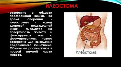 Понятие стома и особенности ухода за пациентами со стомами ...