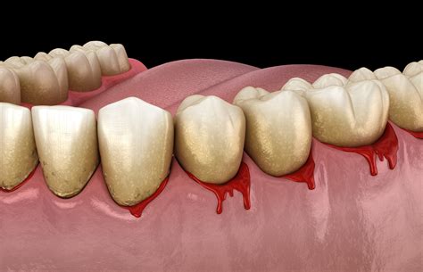 bleeding gums arkansas periodontal  implant associates