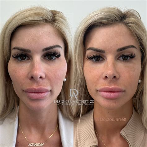 Dissolving Filler with Hyaluronidase - Designer Aesthetics by Dr