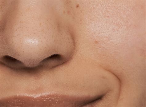 How to Get Rid of Blackheads | Clinique
