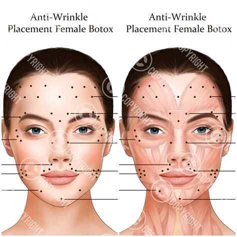 printable botox injection face map