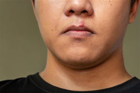 Herpes virus and infection treatment. Men lips affected by herpes