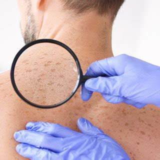 Lentigo/Lentigines - Dermatologist in Glastonbury, CT | Dermatology ...