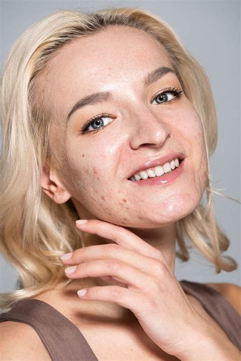 Portrait of Cheerful Woman with Acne Stock Photo - Image of beauty ...