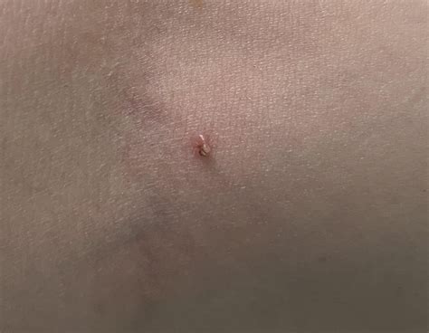 how to know if a skin tag is falling off