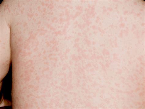 measles pictures early stages - pictures, photos