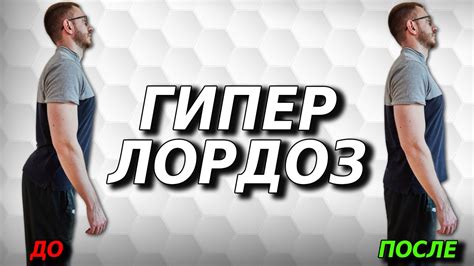 Простой и эффективный комплекс упражнений при поясничном гиперлордозе ...