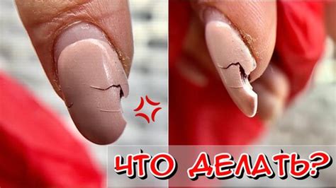 Сломала ноготь что делать? Травма ногтя / Ноготь отошел от пальца, что ...