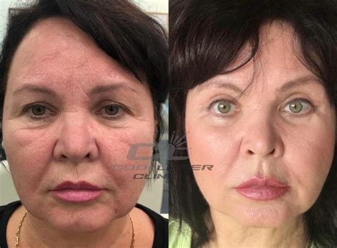 Пластика лица в Киеве на Печерске. Лицензия МОЗ - Coolaser Clinic