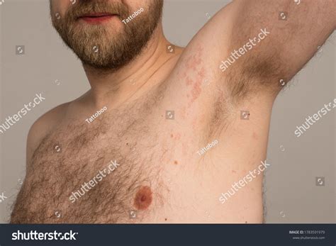 Allergy Reaction Red Spots On Body Stock Photo 1783591979 | Shutterstock