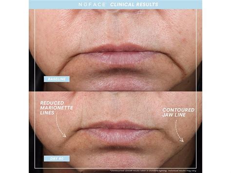 NuFACE Trinity+ Pro Starter Kit | LovelySkin
