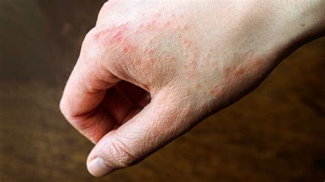 8 Common Types of Rashes | Christ Memorial