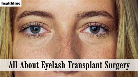 Eyelash Transplant Surgery: Pros, Cons, and Cost | Eyelash implants ...