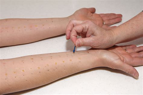 What Is An Allergy Skin Test? - Premier Allergy