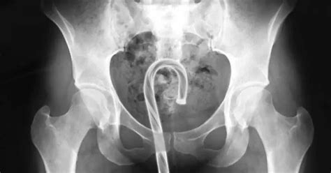 Most bizarre objects people put in their bodies before ending up at A&E