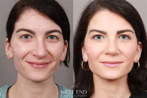 Plastic Surgery Before And After Nose Jobs