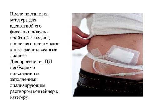 Перитонеальный диализ - презентация онлайн