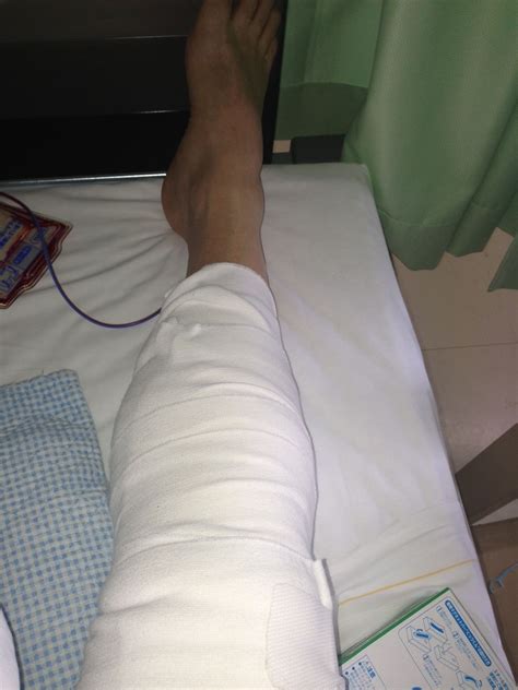ACL Surgery Summary – McBlog