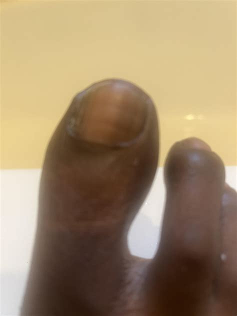 Dark line on right side of big toenail(Picture) A bit concerned about
