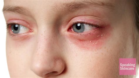 Redness Around Eyes: Why Is The Skin Around My Eyes Red? Causes ...