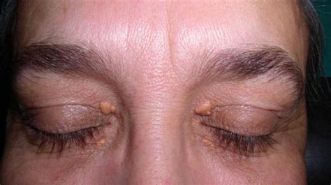 Leukemia-Associated Ocular Manifestations and Their Management: A ...