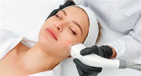 Laser Hair Removal Sideburns: Permanent Removal