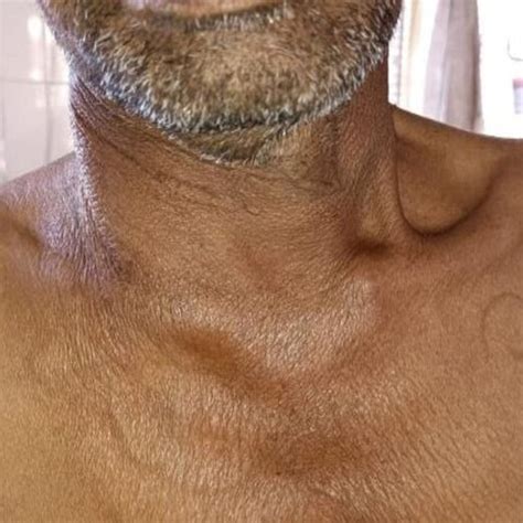 Neck swelling resolved at the time of discharge. | Download Scientific ...