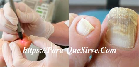Para Que Sirve El Tratamiento Para La Onicomicosis Severa marzo - 2025