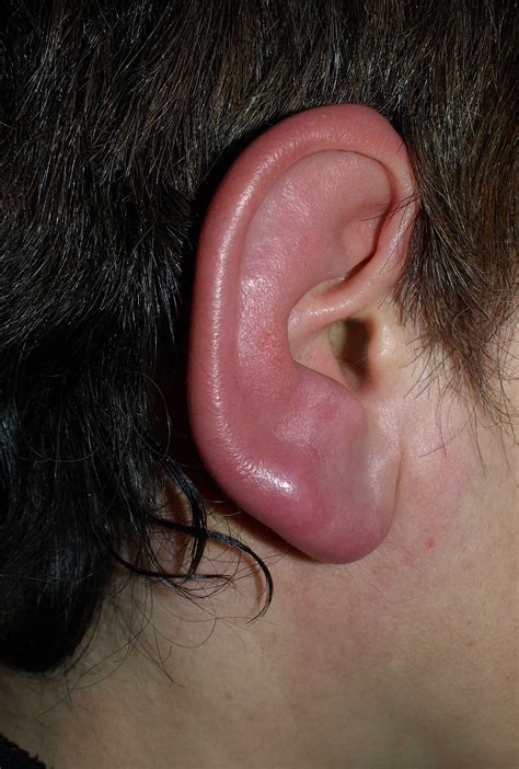 Erysipelas | Concise Medical Knowledge