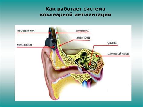 Педагогическая реабилитация детей после кохлеарной имплантации ...