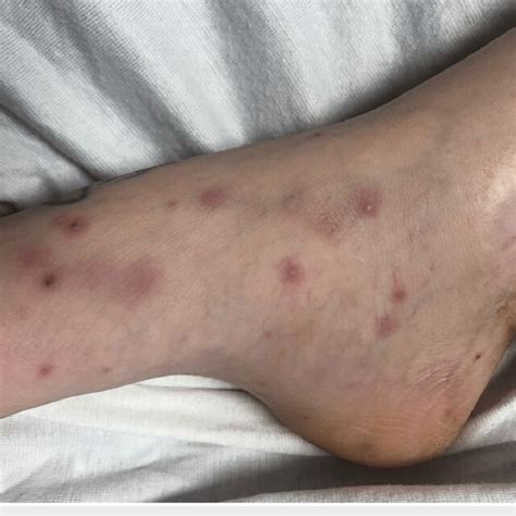 Osler nodes seen as dark, raised, and purplish covering the medial ...