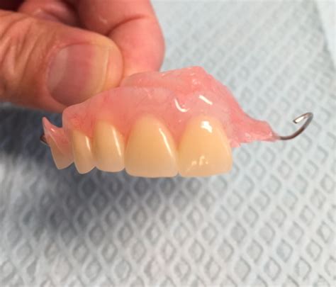Flexible partial denture upper front teeth | Hummingbird Dental | Voted ...