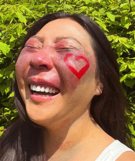 A Woman With a Face Birthmark Shares What Is Like to Always Have People ...