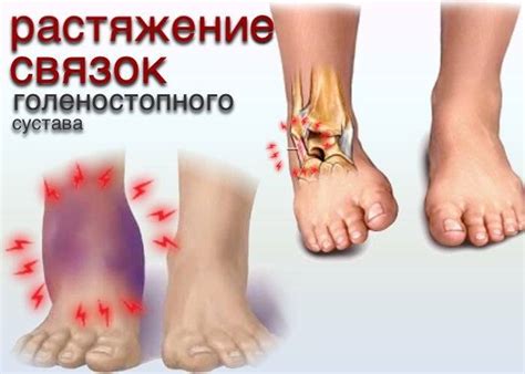 Растяжение связок голеностопного сустава, лечение в домашних условиях