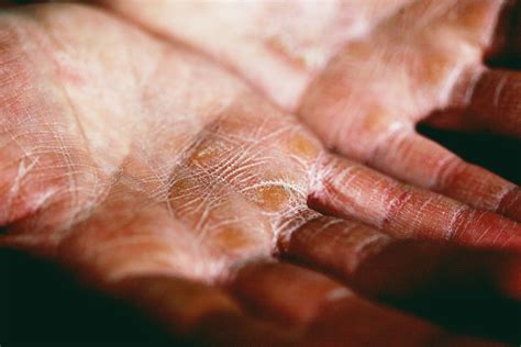 Why Does My Morning Urine Smell Like Sulfur? - Smelly Urine