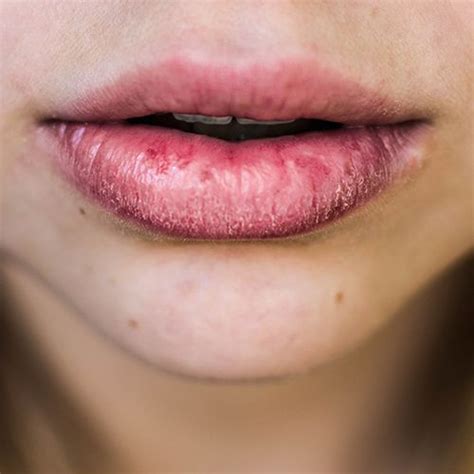 Dry Lips: Causes And Hydrating Lip Care Routine | Eminence Organic Skin ...