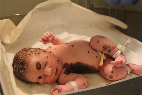 Born with Congenital Melanocytic Nevus – Dylan's amazing journey