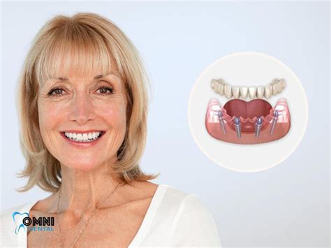 All-on-4 Dental Implants Step by Step - Omni Dental
