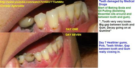 Can you really Re-Grow/ReMineralize your Teeth and Gums? My Oil Pulling ...