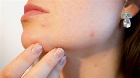 Bacterial Tug of War May Cause Acne — NOVA Next | PBS