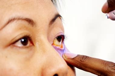 NHS 111 Wales - Health A-Z : Herpes simplex eye infections