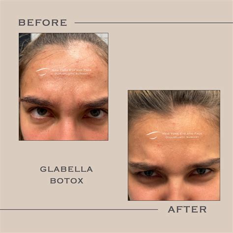 Glabella Botox Gallery - West Harrison, NY: New York Eye and Face ...