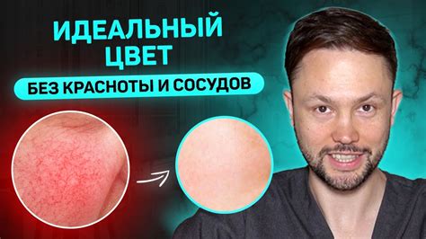 Как избавиться от покраснений и сосудов на лице? Лучшие советы и ...