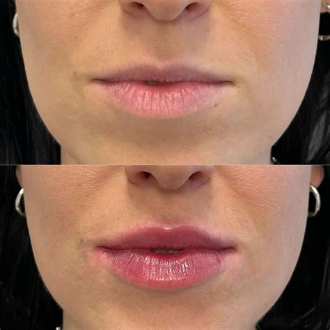 Lip Filler Swelling Stages: How Long Does It Last? – It's Me & You