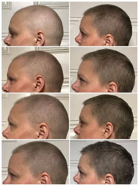 how to grow out hair after chemo