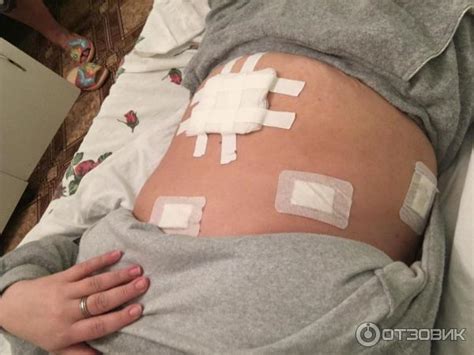 Отзыв о Лапароскопическая холецистэктомия (операция по удалению ...